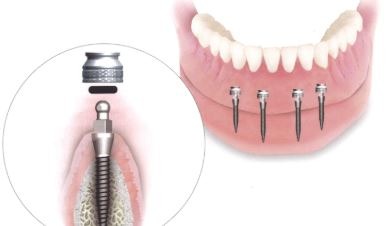 snap-on-denture-procedure