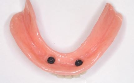 snap-on-dentures-treatment