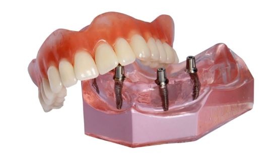 snap-on-overdentures