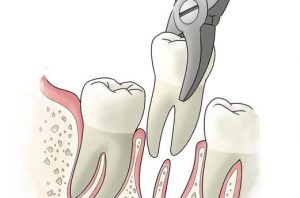 tooth-extraction-post-op