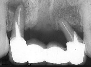 tooth-loss-defective-dental-prosthesis