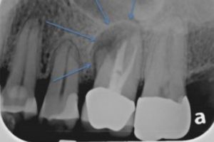 tooth-loss-dental-infection