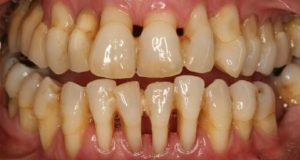 tooth-loss-gum-disease