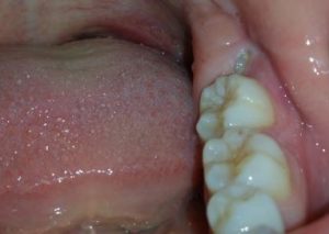 tooth-loss-impacted-wisdom-teethtooth-loss-impacted-wisdom-teeth