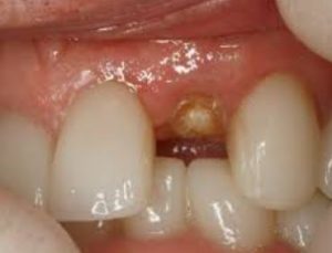 tooth-loss-non-restorable