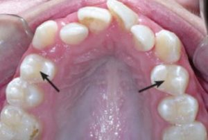 tooth-loss-orthodontic-extraction