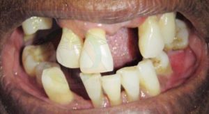 tooth-loss-significance