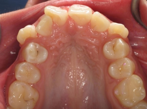 supranumerary-extra-teeth