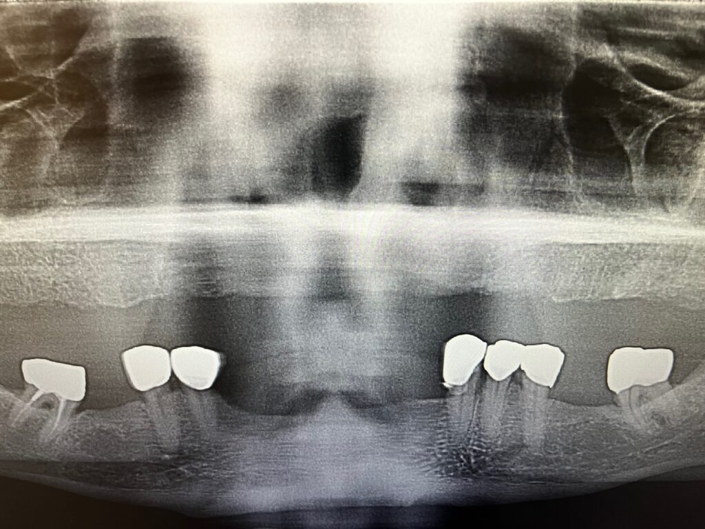before-all-on-6-implant-surgery