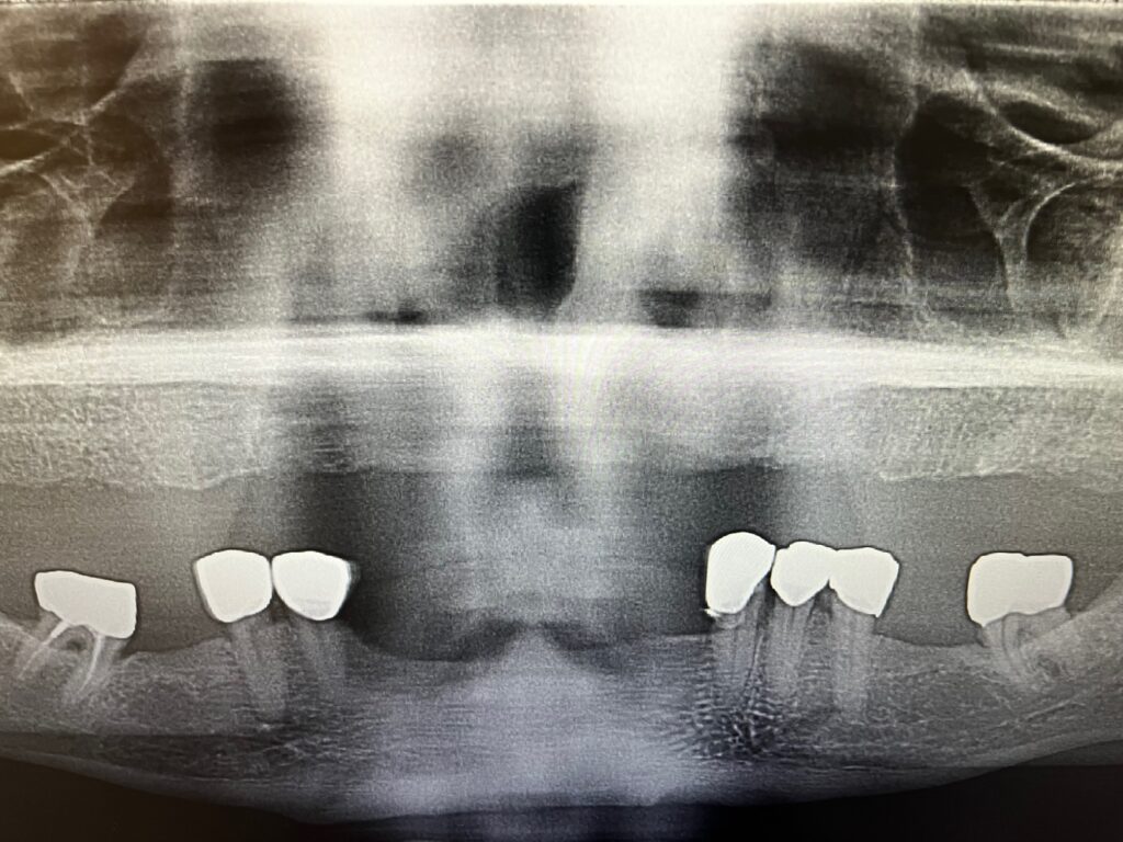 Study Case: All-on-6 Upper Zirconia Bridge – Oceansight Dental & Implants