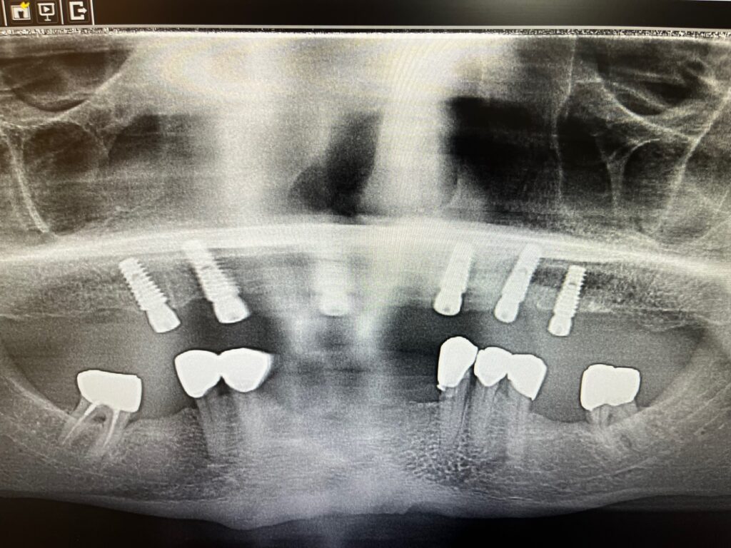 Panoramic X-ray of 6 implants placed in the upper jaw.