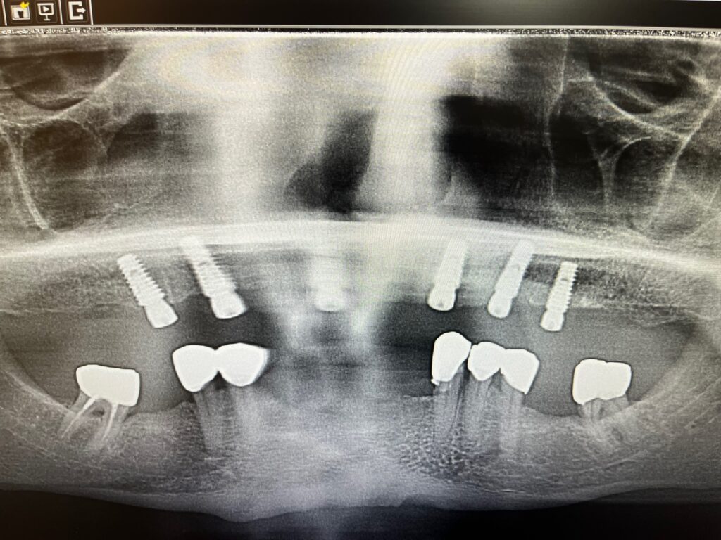 all-on-6-dental-implants-implant-surgery Panoramic X-ray of 6 implants placed in the upper jaw.
