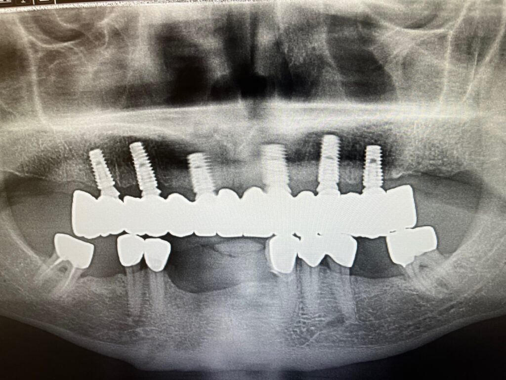 all-on-6-dental-implants-final-xray