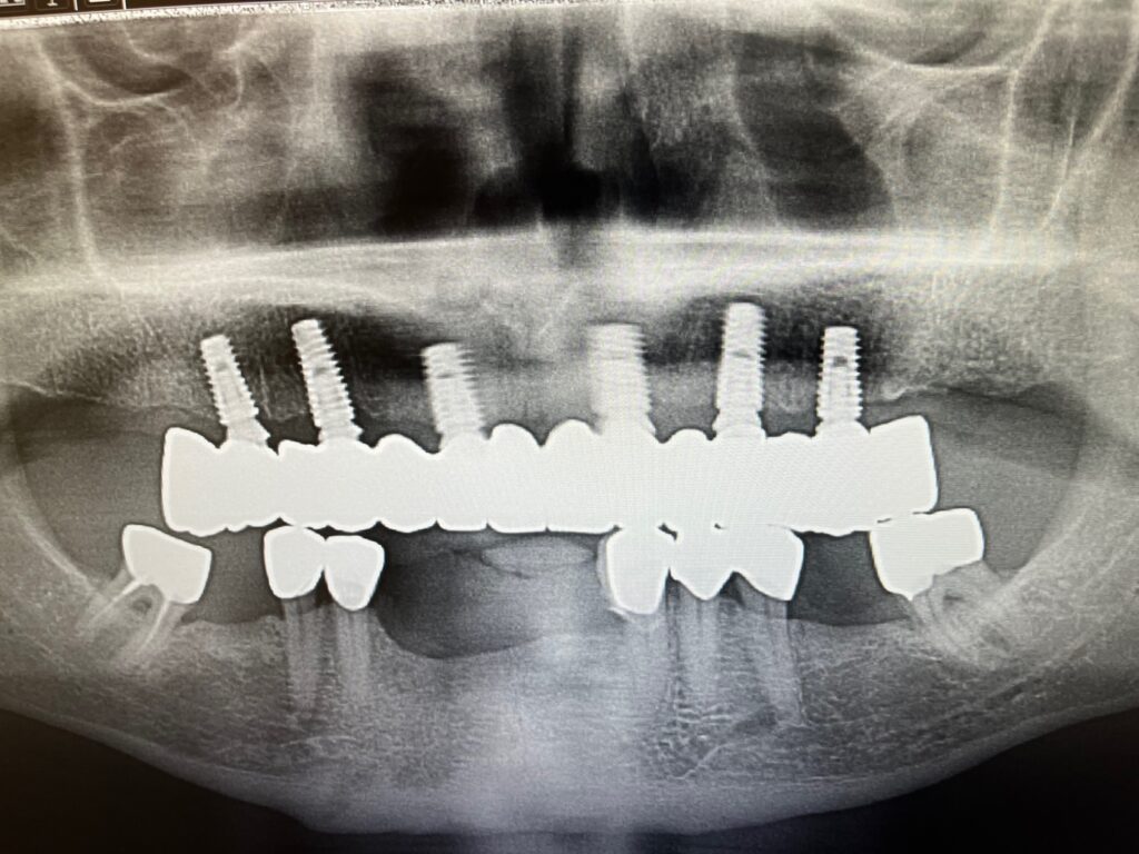 all-on-6-dental-implants-final-xray all-on-6-dental-implants-final-xray