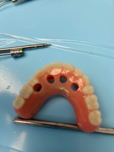 Sample case of 4-holes cut through the denture so that it can be used as a tempoary while fabricating the permanent bridge.