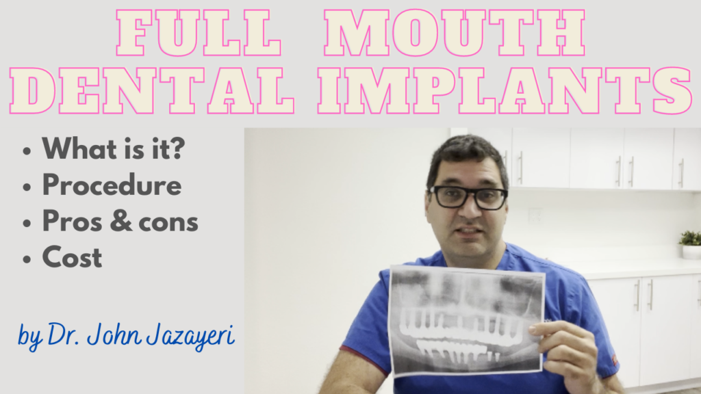 Full mouth dental implants screenshot final