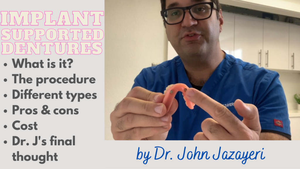 Implant-Supported Dentures final thumbnail