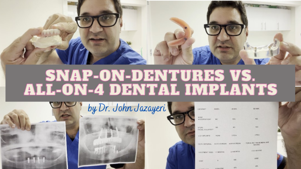 Snap-on-denture vs all-on-4 implants screenshot final