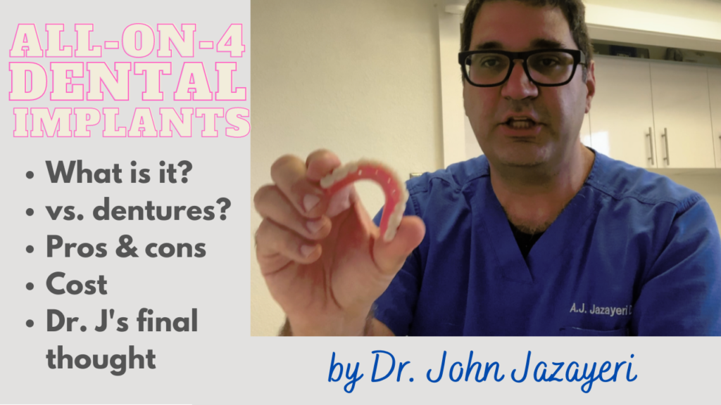 all-on-four-dental-implants-final-thumbnail