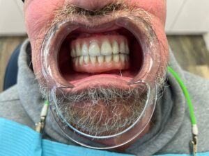 all-on-four-dental-implants