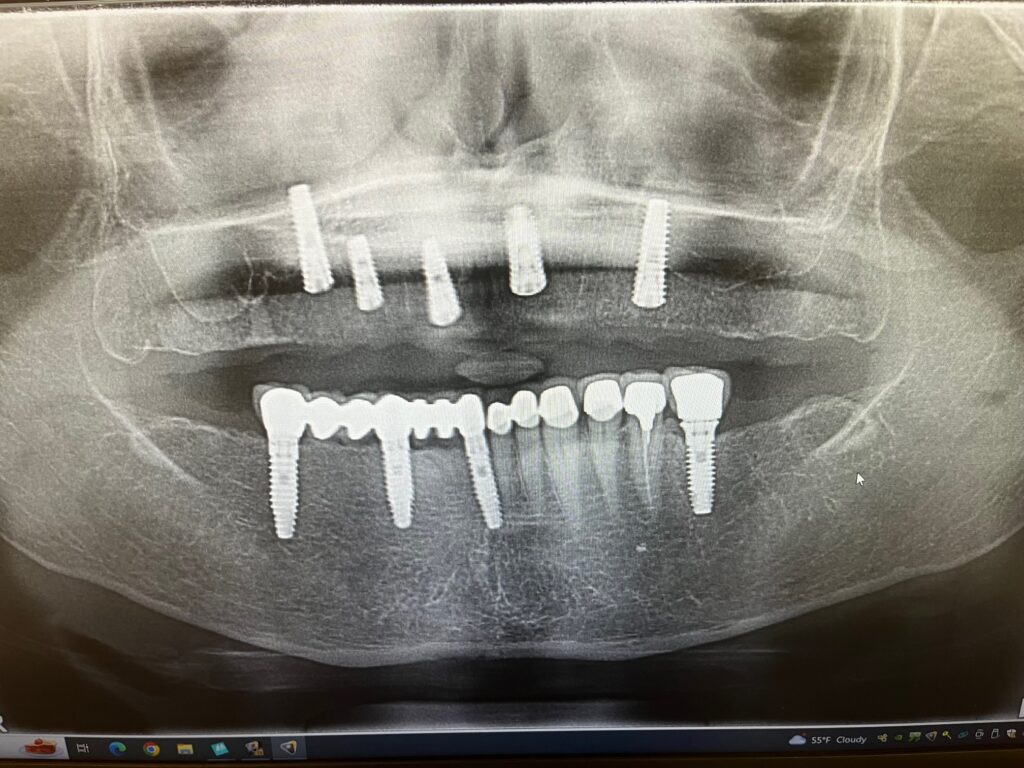 xray2 after-all-on-five-implants